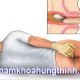 khám trĩ ở khoa nào