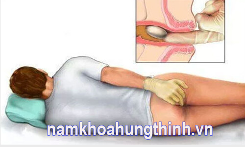 khám trĩ ở khoa nào