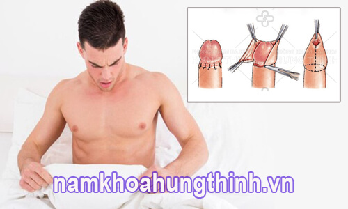 Sau khi cắt bao quy đầu bị bầm tím