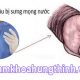 sau khi cắt bao quy đầu bị mọng nước