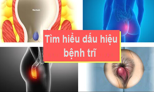 Tìm hiểu về bệnh trĩ