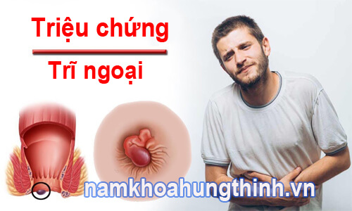 triệu chứng của bệnh trĩ ngoại