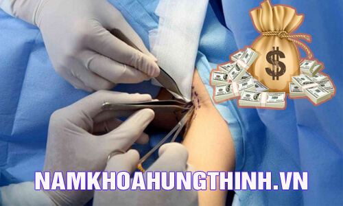 cắt tuyến mồ hôi nách bao nhiêu tiền