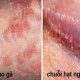 phân biệt chuối hạt ngọc dương vật và sùi mào gà