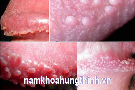 chuỗi hạt ngọc dương vật