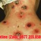 Bệnh giang mai co tái phát lại không
