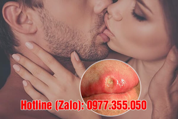 giang mai có lây qua đường nước bọt không