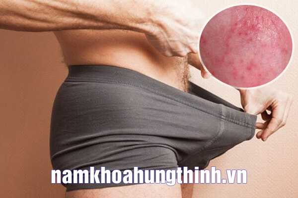 ngứa dương vật sau khi quan hệ là bị làm sao